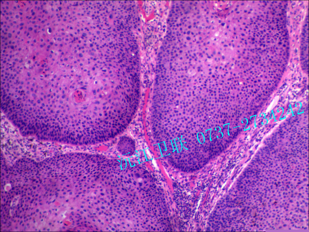 基底細(xì)胞癌